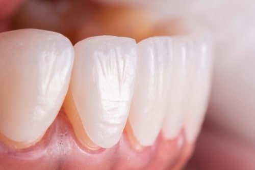 Porcelain Veneers cost