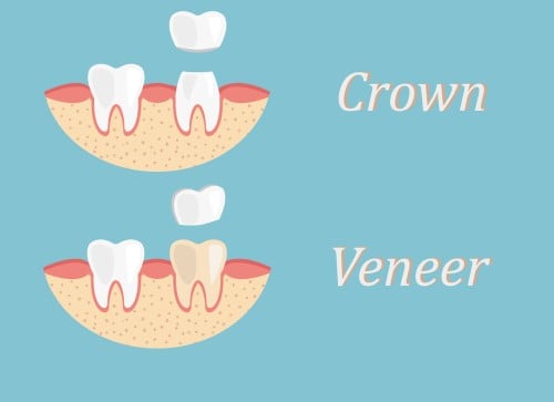 What Is The Difference Between Veneers and Crowns