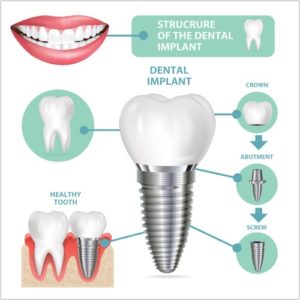 foreign patients prefer Dental Implants in Turkey