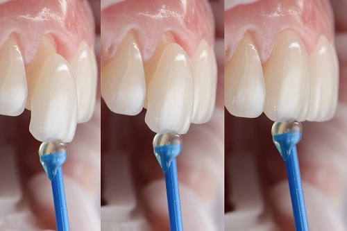 Dental Veneers Procedure