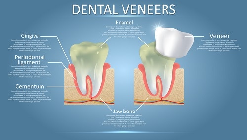 What is Dental Veneer