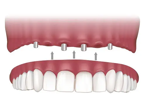 The All-on-4 Dental Implant Procedure