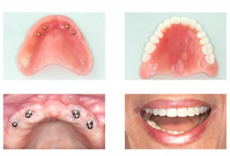 Affordable Dentures And Implants