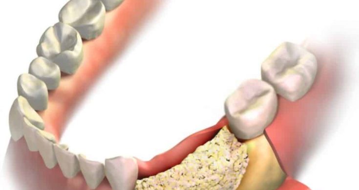 Bone Graft For Dental Implants