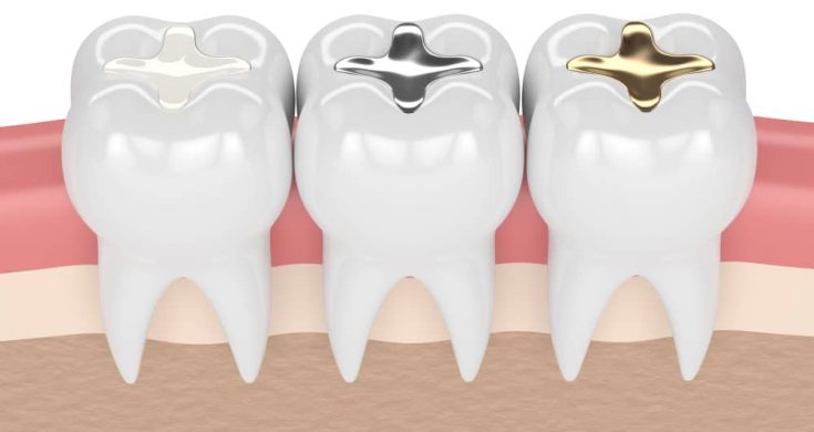 Dental Fillings