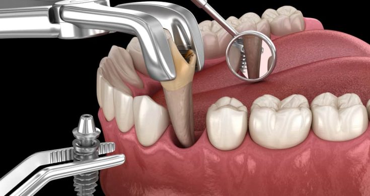 Immediate Dental Implants